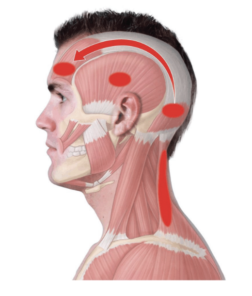 <p><em>Head pain from soft tissue disorders in the cervical spine</em></p><ul><li><p>C1-C3 dysfunctions of facet joints = primary cause</p></li><li><p><strong>Pain</strong> :</p><ul><li><p>Localized : Neck/occipital region</p></li><li><p>Radiates : Forehead/temple, ears, eyes</p></li></ul></li><li><p><strong>Causes</strong> : trauma, posture, Women 4x : Men 1x</p></li><li><p><strong>Symptoms</strong> : Consistent unilateral pain that starts in neck & spreads</p></li><li><p><strong>Special Tests</strong> :</p></li></ul><ol><li><p>Cervical Flexion-Rotation Test</p></li><li><p>Craniocervical Flexion Test</p></li><li><p>Deep Neck Flexor Endurance Test</p></li></ol><p></p>