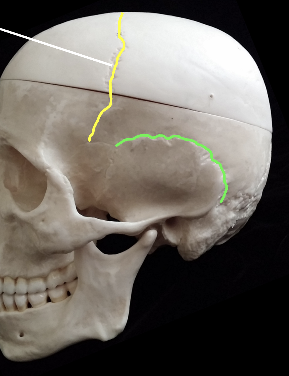 <p>What is the suture highlighted?</p>