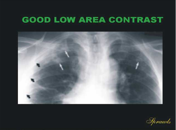 <p><span>Parts of the body with low contrast between its body parts will give us a better image</span></p>