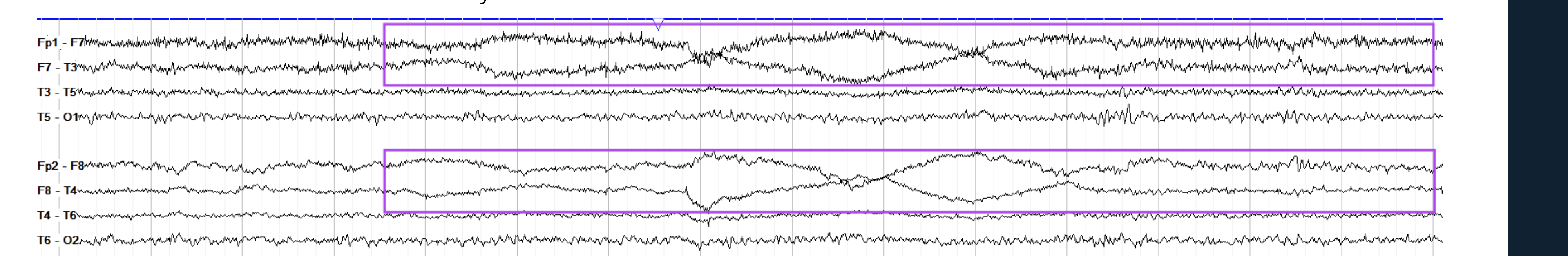 <p>Roving Eye movements, Diffuse slowing, bilateral frontal</p>