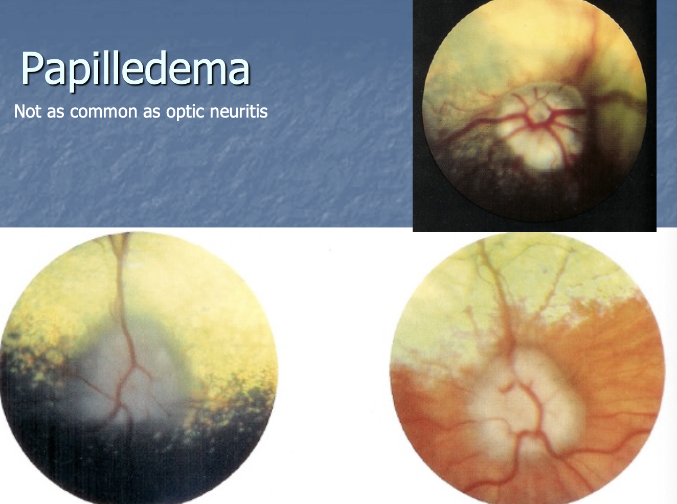 <p>edema of optic disc with normal vision</p>