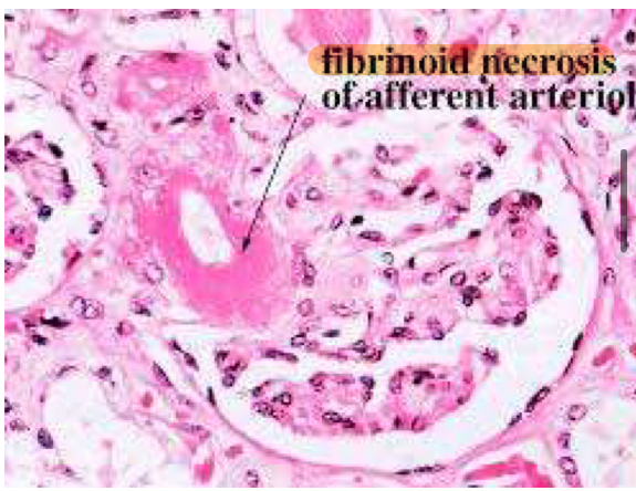 <p>Malignant nephrosclerosis (fibrinoid necrosis)</p>