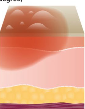 <p>Deep partial thickness Second degree burn?</p>