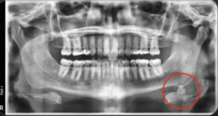 <p>How is this lesion described in terms of internal structure?</p>