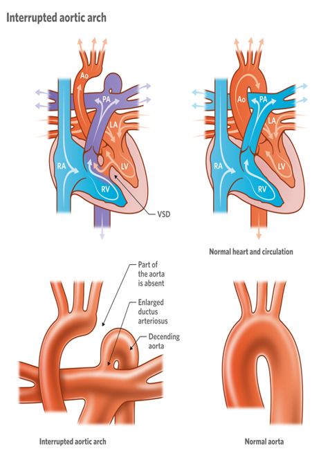 <p>absence of a segment of the ao arch</p>