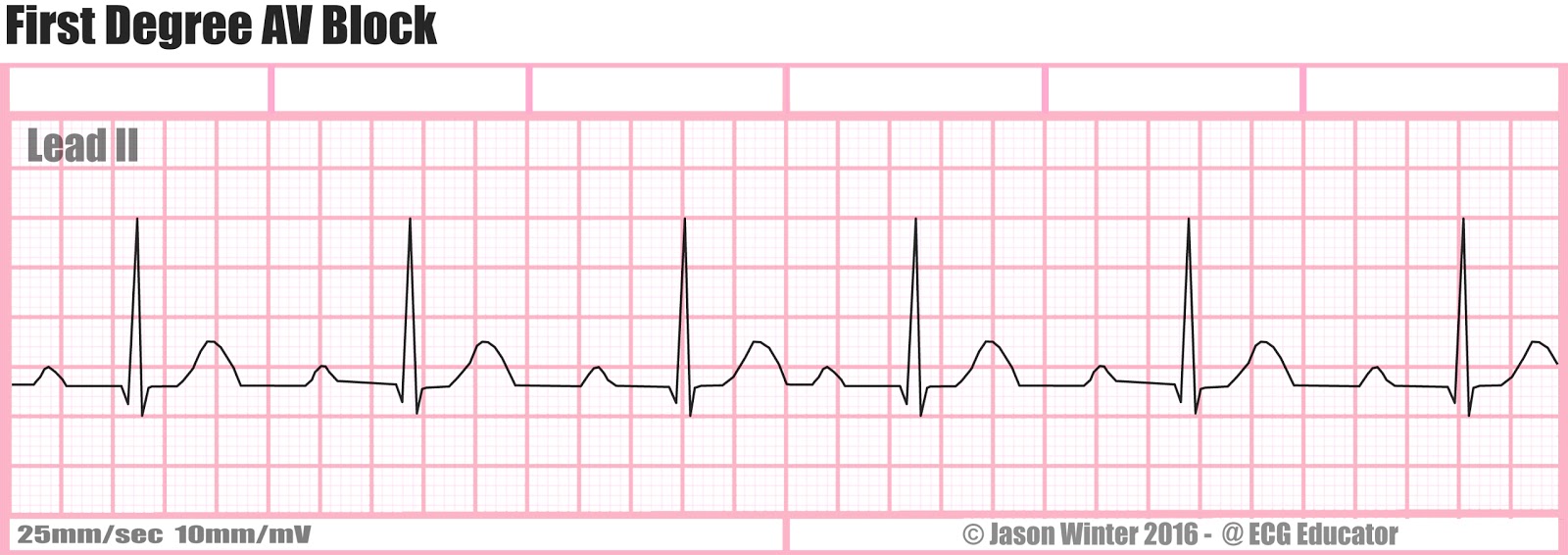 <p>First-degree AV block.</p>