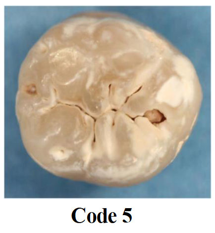 <p>Distinct cavity with visible dentin</p>