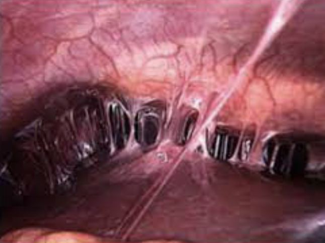 <p>⚠️26.This “violin-string” lesion in PID caused by? A.Neither B.Neisseria only C.Chlamydia only D.Both</p>