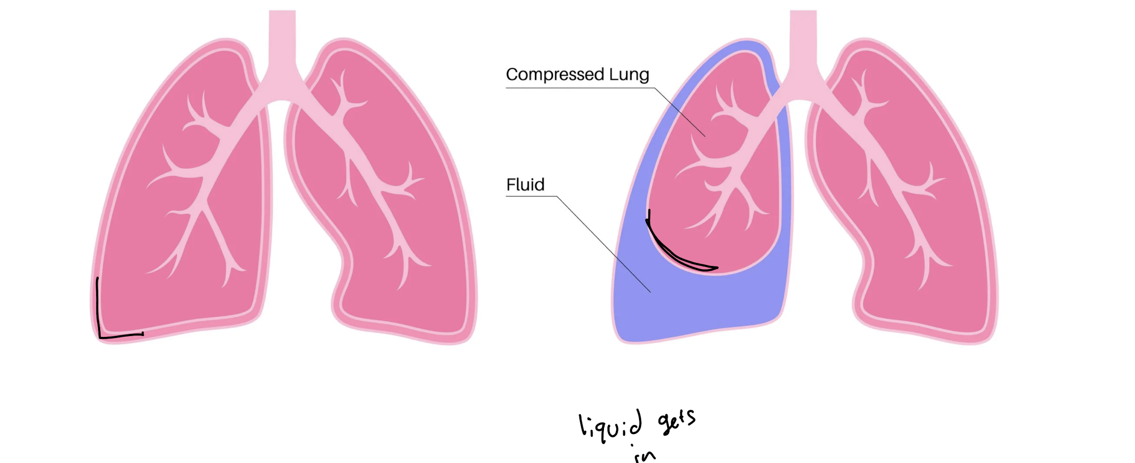 <p>liquid gets into the pleura cavity and compresses the lung</p>