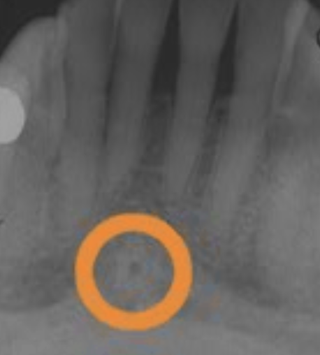 <p>genial tubercles</p>
