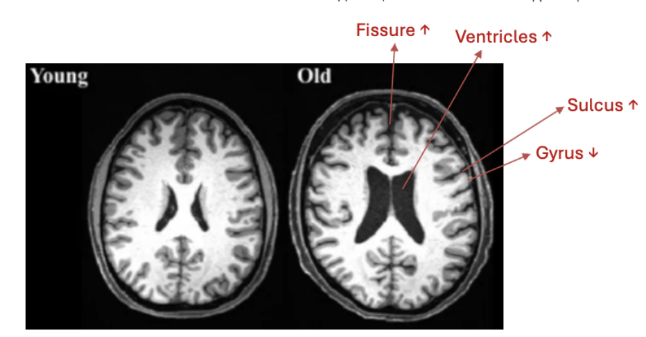 <p>structural changes in the brain</p><p><em>decreased vs increased?</em><br><em>brain size, weight, volume</em><br><em>metabolic activity</em><br><em>neuron loss/shrinkage</em><br><em>ventricles</em><br><em>glial cells</em></p>