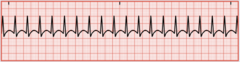 <p>Also known as narrow complex tachycardia. The impulse is not following the normal electrical conduction pathway. The heart rate is above 150/min, P waves are usually not visible</p>