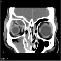 <p>imaging</p><p>-CT scans: orbits with IV contrast</p><p>-Looks for orbital involvement, abscess, sinusitis</p>