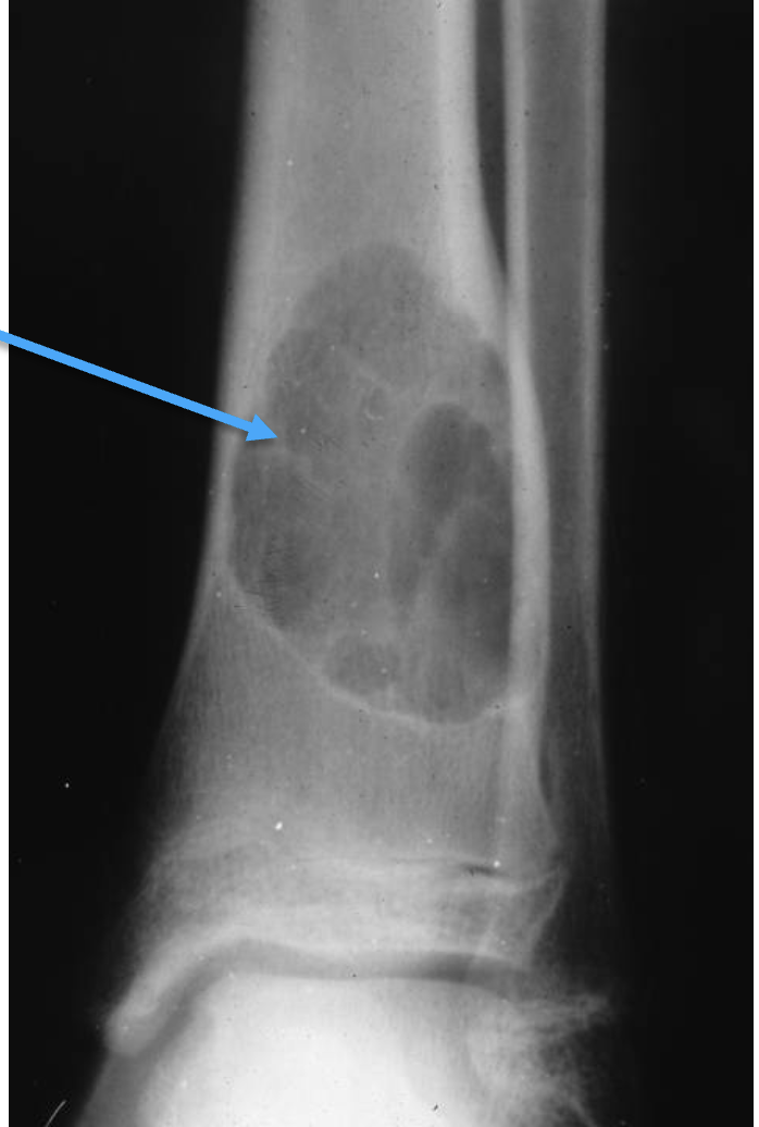 <p>What bone tumour is this, what bone is it in and what can be seen?</p>