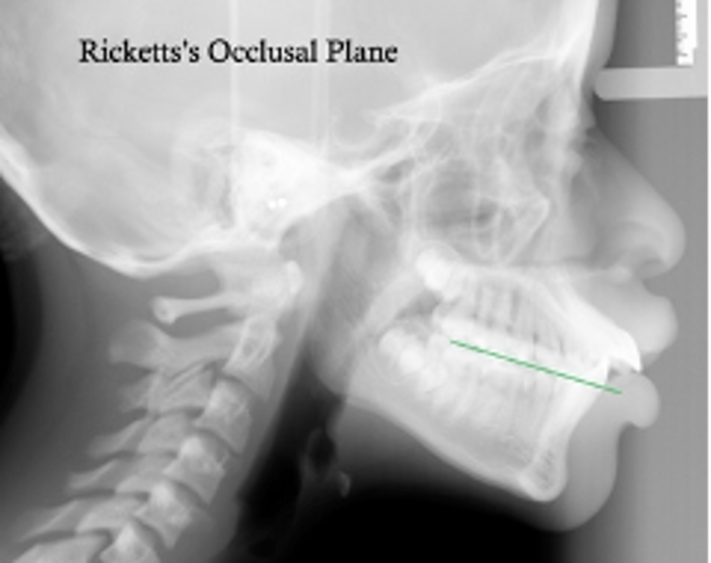 <p>which reference plane:</p><p>- Point 1: Molar occlusal contact</p><p>- Point 2: 1st premolar occlusal contact</p>