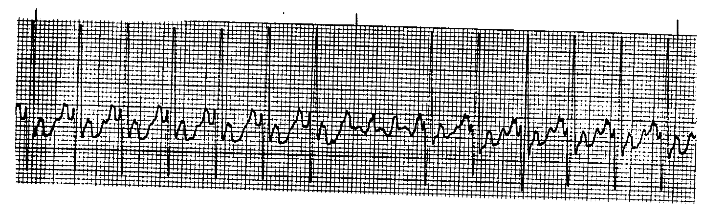 <p>What ECG is this? </p>