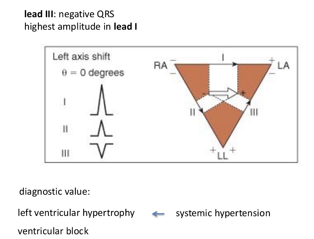 <p>Systemic hypertension by the left ventricle and so the activation goes to that side and the largest R wave is in league 1</p>