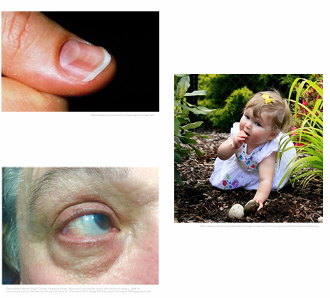 <ul><li><p>General S/S of Anemia (gradual onset)</p></li><li><p>PICA (craving nonfood substances)</p><ul><li><p>Dirt, clay, ice, laundry starch, cardboard, hair</p></li></ul></li><li><p>Koilonychias (spoon shaped nails)</p></li><li><p>Blue sclerae (white part of eye appears blue)</p></li></ul><p></p>