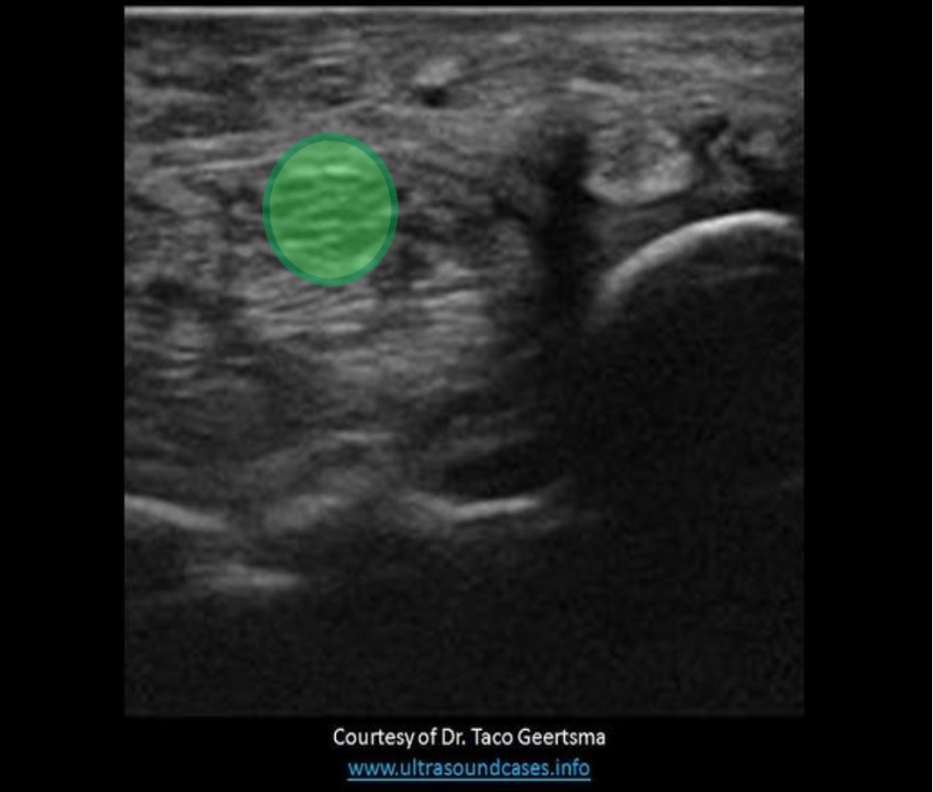 <p>The median nerve is a hypochoic striated ovoid structure in the anterior wrist.</p><p class="p1">This nerve is compressed/injured in carpal tunnel syndrome.</p>