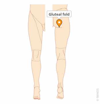 <p>Indentation below buttcheek</p>