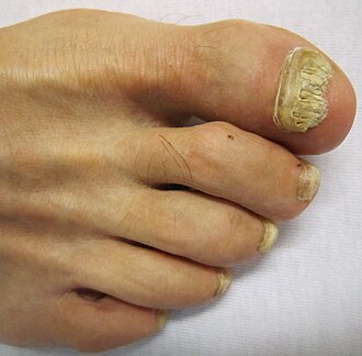 <p>A fungal infection of the nails that causes discoloration, thickening, and possible separation from the nail bed. </p>