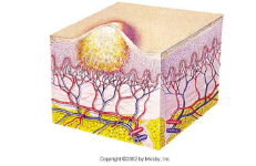 <ul><li><p>elevated, circumscribed</p></li><li><p>superficial cavity that contains purulent</p></li><li><p>Any size or shape</p></li></ul><p></p>