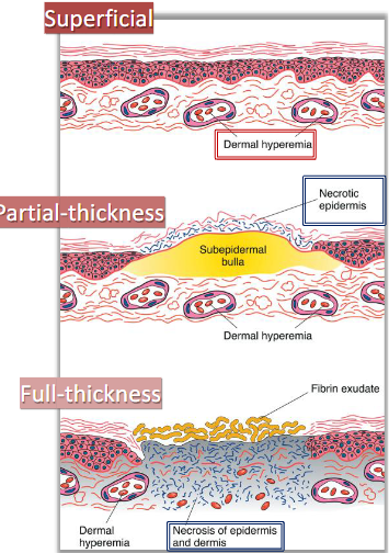 <ul><li><p>% of body, depth, internal injuries (e.g smoke inhalation)</p></li><li><p><u>superficial</u> (epidermis, red, <strong>painful w/ no blisters</strong> or scar), <u>partial thickness</u> (dermis, pink, <strong>painful w/ blister</strong> + wet), <u>full thickness </u>(subcutaneous, white/<strong>charred,</strong> dry, <strong>painless</strong>) </p></li></ul><p></p>