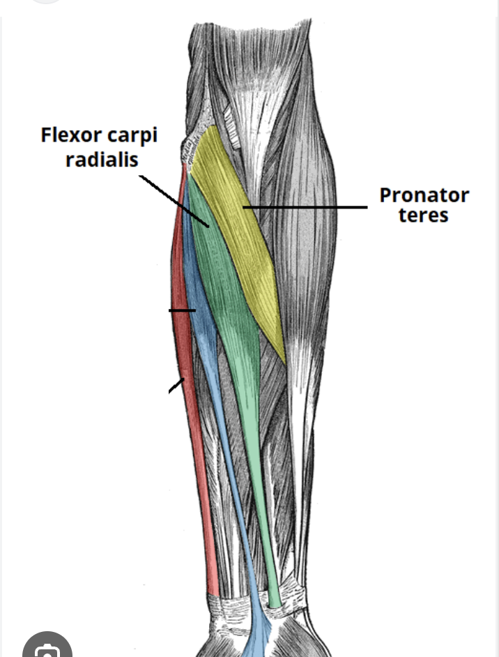 <p>Common flexor origin</p><ul><li><p>Especially flexor carpi radialis and pronator teres</p></li></ul><p></p>