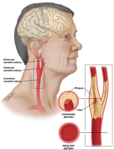 <p><span>carotid; ex. carotidectomy, carotidal</span><br><span>loan word: carotid </span></p>