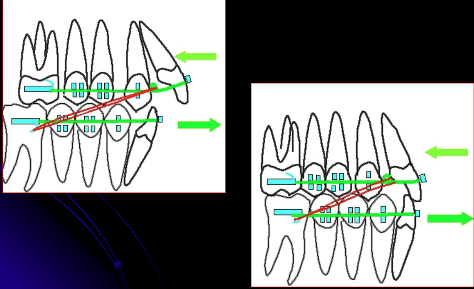 <p>ID the elastics class:</p><p>- Connects maxillary teeth that are more anterior to mandibular teeth that are more posterior</p>