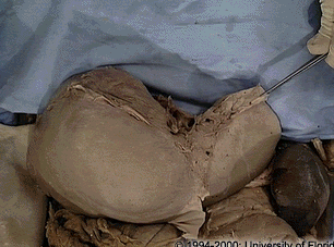 <p>what structure on the liver is being held by the probes?</p>