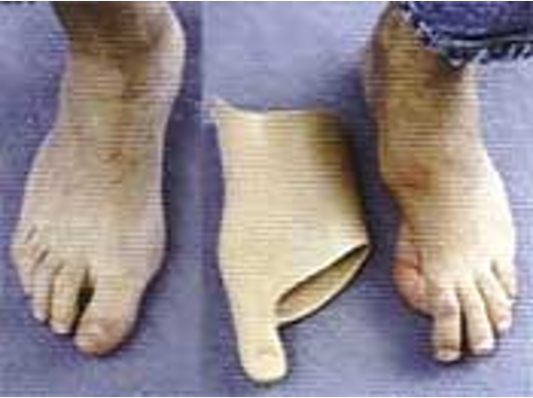 <p>loss of great toe lever </p>