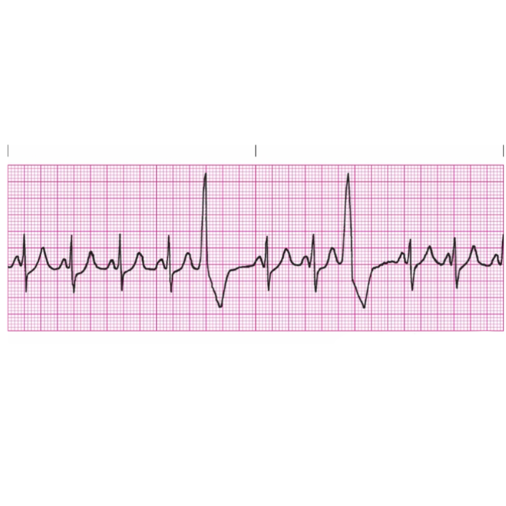 <p>Rules for Premature Ventricular Complex includes </p>