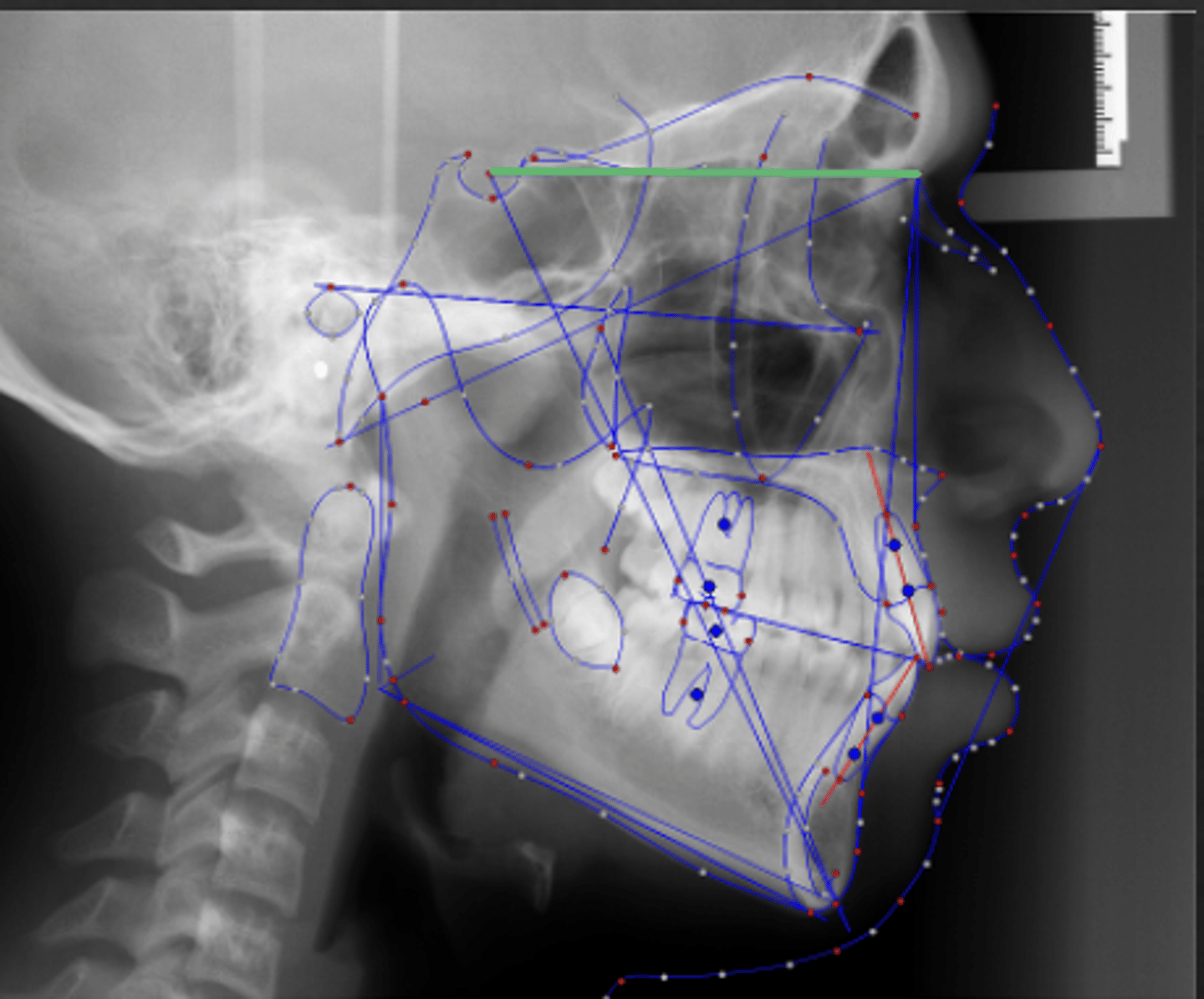 <p>which reference plane:</p><p>- Sella to Nasion</p><p>- Cranial base reference line</p><p>- According to Bjork, the cranial base grows along the Sella Nasion line</p>