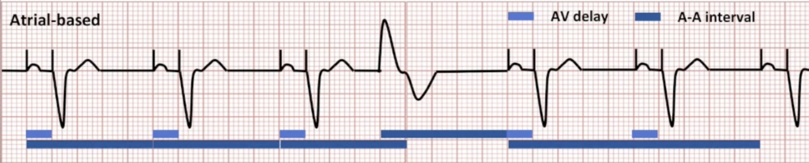 <ul><li><p>PVC defined by the device:</p><ul><li><p>Two consecutive ventricular events</p></li><li><p>No intervening atrial events</p></li><li><p>Second event is VS</p></li></ul></li><li><p>Atrial-based timing: PVC triggers new A-A interval</p></li></ul><p></p>