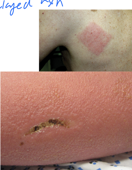 <ul><li><p>Red papules, plaques, </p></li><li><p>sharply circumscribed vesicles, </p></li><li><p>swelling, </p></li><li><p>itching, </p></li><li><p> occasionally blister formation. = poison ivy </p></li></ul><p></p>