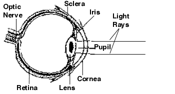 <p>Clouding of the crystalline lens causing visual impairment. Congenital or Acquired</p><ul><li><p>Congenital: congenital rubella, genetics, metabolic disorders</p></li><li><p>Acquired: Juvenile Idiopathic Arthritis (JIA)-associated uveitis, Trauma, Steroid Exposure</p></li></ul><p><strong>RF</strong>: steroid exposure, rubella, Down Syndrome, FHx</p><p><strong>Sx</strong>: leukocoria, poor visual development, strabismus, ↓ fixation in infants, constant glare</p><p><strong>Ix</strong>: Clinical Exam/Opthalmoscope, Slit-Lamp, B-Scan US</p><p><strong>Mx</strong>: early surgical removal (prevent ambylopia), Intra-Ocular Lens (IOL → lens replacement)</p><ul><li><p><em>Mx is dependent on cataract density</em></p></li></ul><p><strong>Cx</strong>: amblyopia (blocked visual input → lazy eye)</p>
