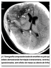 <p>- gunshot wounds and penetrating sharp objects can penetrate the skull into the brain</p><p>- often ballistic traumatic causes widespread traumatic cerebral edema and ICP issues</p>