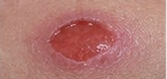 <p><span>Partial-thickness loss of skin with exposed dermis.</span></p>
