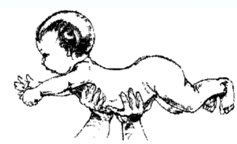 <ul><li><p>righting reaction </p></li><li><p>inset is 3-5 months w/ peak at 5-6 months</p></li><li><p>helps integrate TLR</p></li><li><p>extension of head, neck, back, and hips; allows pivot on abdomen</p></li><li><p>basically when suspend baby from belly, the baby will extend arms/legs and raise the head</p></li></ul><p></p>