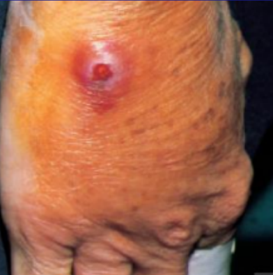 <p>focal suppurative lesions which has resulted from an infection (folliculitis) that extend into subcutaneous tissue; large, raised, superficial abscesses</p><p>large abscess forms around a hair follicle</p>