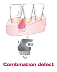 <p>Intrabony defect with varying walls (e.g., 2 walls coronally, 3 walls apically).</p><p>(Explanation: Combination defects have complex anatomy, requiring tailored regenerative approaches based on the number of walls at different levels of the defect.)</p>