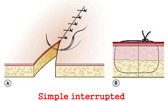 <p>most commonly used</p><p>suture goes through one side, comes up through the other side and tied in a knot at the top</p><ul><li><p><strong>advantages:</strong></p><ul><li><p>can be placed quickly</p></li><li><p><span style="color: red;">tension adjusted individually</span></p></li><li><p>if one suture is lost, <span style="color: red;">remaining sutures stay in position</span></p></li></ul></li></ul><p></p>