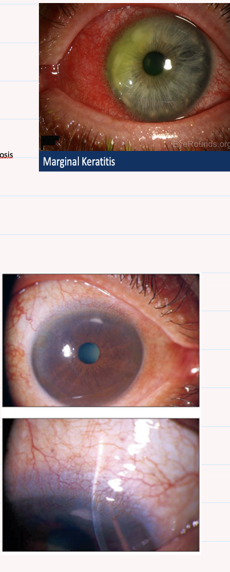 <p>Describe this image and give diagnosis?</p>