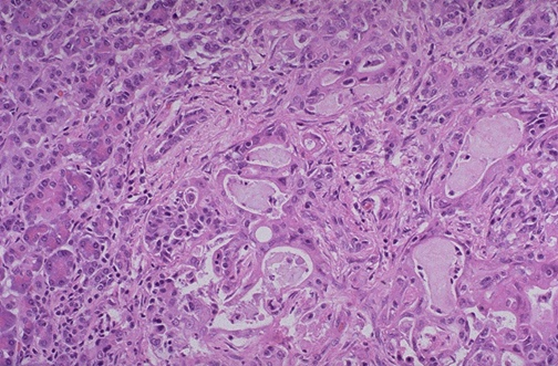 <p>normal on left</p><p>small irregular glands</p>