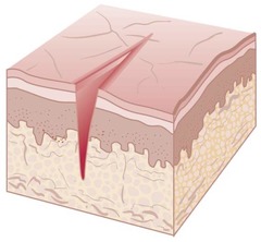<p>Secondary lesion; a linear, wedge-shaped crack extending into the dermis</p>