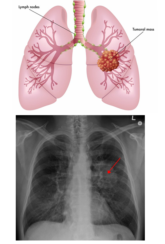 <p>Highly aggressive and frequently fatal malignancy originating in the respiratory epithelium.</p><ul><li><p>Smoking causes about 85% of all lung cancer</p></li><li><p>Symptoms</p><ul><li><p>Chronic Cough</p></li><li><p>Coughing up Blood</p></li><li><p>Excess Pulmonary Mucus</p></li><li><p>Increased Pulmonary Stress</p></li></ul></li><li><p>Types: </p><ul><li><p>Non-Small</p></li><li><p>Small Cell</p></li></ul></li></ul><p></p>