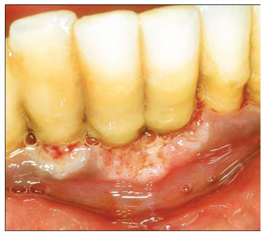 <p>1.what is this lesion?</p><p>2. how to treat/ manage it?</p><p>3. classification of oral lesion in HIV?</p>