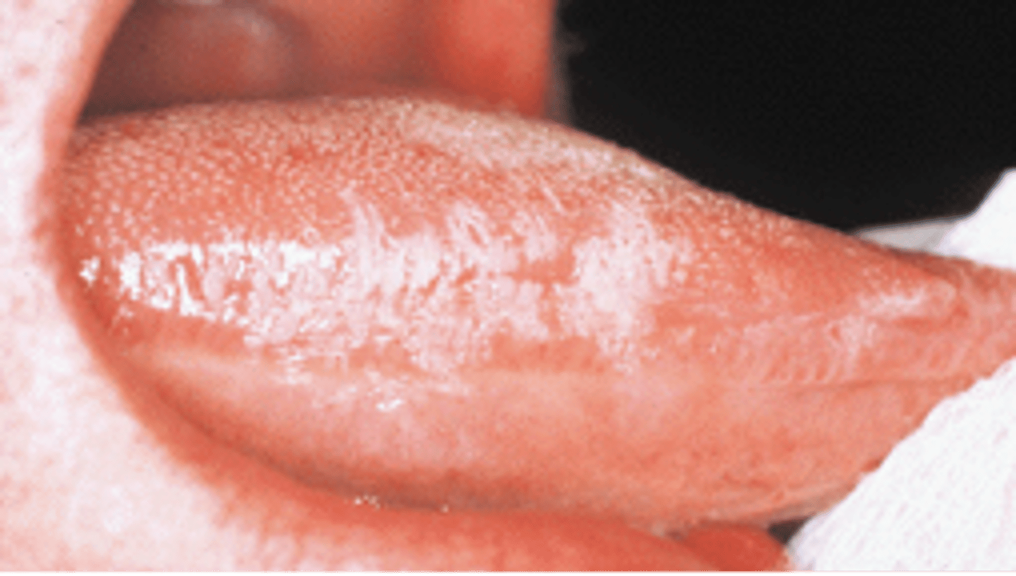 <p><br>a white rough patch that arises on the LATERAL tongue. Usually seen in immunocompromised and is due to EBV induced squamous cell hyperplasia. NOT pre-malignant.</p><p><span>Isolation of the Eppstein-Barr virus is the most reliable method for diagnosis of this lesion on the lateral border of the tongue. What is this lesion called, and what systemic disease is it most often associated with?</span></p>