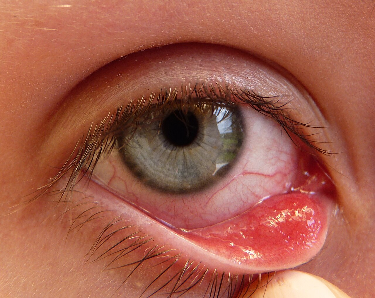 <p>infrection or retention cyst of meibomian gland (beady module on eye)</p>
